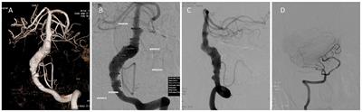 Multiple telescoping flow diverter technique in endovascular treatment of a vertebrobasilar dissecting aneurysm: case report